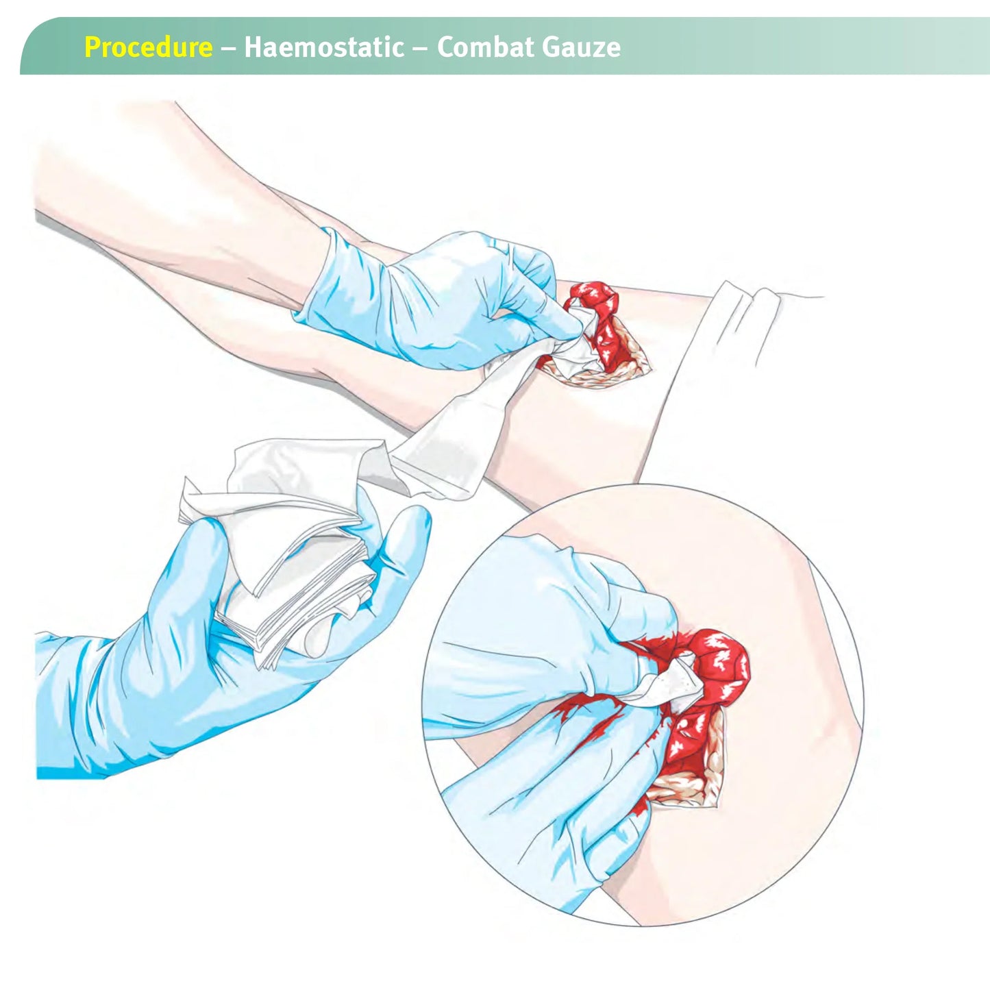 Hemostatic Gauze for Wound Dressing
